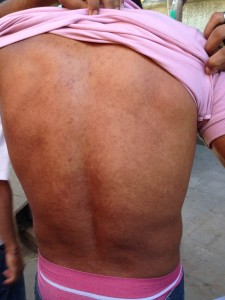 Costas de trabalhador com alergia devido ao contato com cimento